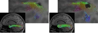 Die Abbildung zeigt eine Rekonstruktion des Fasciculus longitudinalis inferior (ein Fasertrakt des Gehirns), links mit einem herkömmlichen KI-Verfahren, rechts mit dem neuen Hybridansatz. Der Hybridansatz ermöglicht eine vollständigere Rekonstruktion. Zugleich spart er Läsionen wie die dunkle Region in der Detailansicht präziser aus.