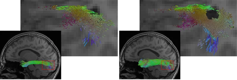 Die Abbildung zeigt eine Rekonstruktion des Fasciculus longitudinalis inferior (ein Fasertrakt des Gehirns), links mit einem herkömmlichen KI-Verfahren, rechts mit dem neuen Hybridansatz. Der Hybridansatz ermöglicht eine vollständigere Rekonstruktion. Zugleich spart er Läsionen wie die dunkle Region in der Detailansicht präziser aus.