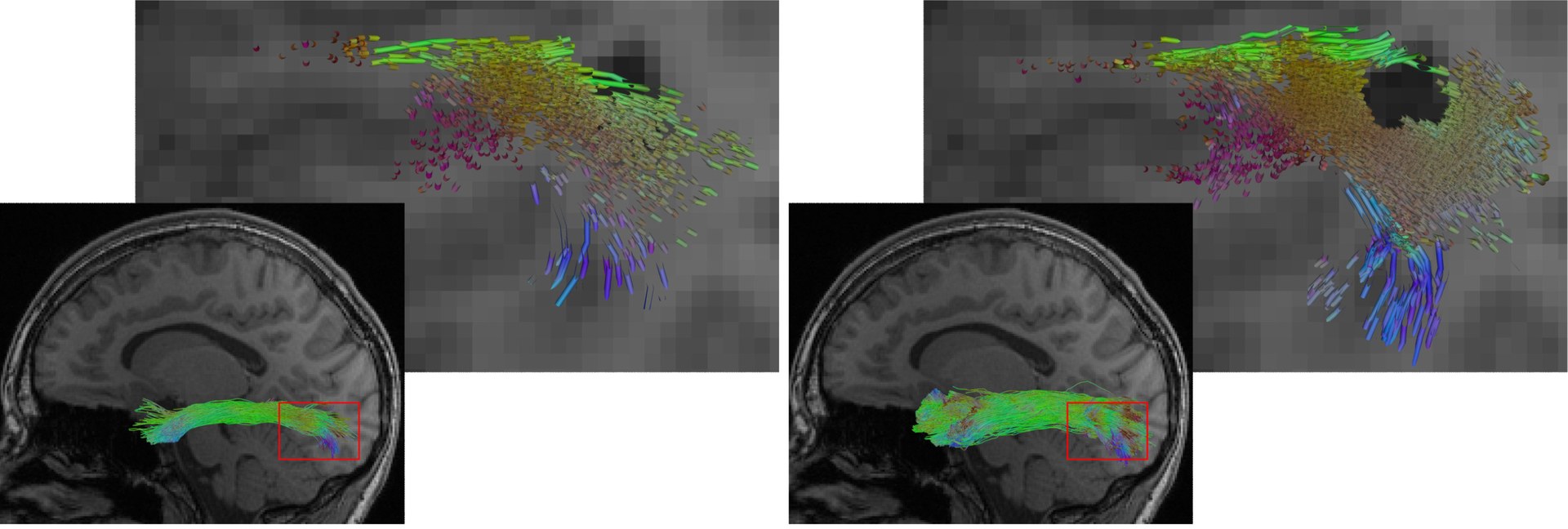 Die Abbildung zeigt eine Rekonstruktion des Fasciculus longitudinalis inferior (ein Fasertrakt des Gehirns), links mit einem herkömmlichen KI-Verfahren, rechts mit dem neuen Hybridansatz. Der Hybridansatz ermöglicht eine vollständigere Rekonstruktion. Zugleich spart er Läsionen wie die dunkle Region in der Detailansicht präziser aus.