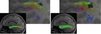 The illustration shows a reconstruction of the longitudinal inferior fasciculus (a fibre tract of the brain), on the left using a conventional AI method, on the right using the new hybrid approach. The hybrid approach enables a more complete reconstruction. At the same time, it more precisely omits lesions such as the dark region in the detailed view.
