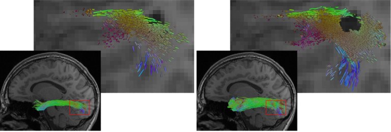 The illustration shows a reconstruction of the longitudinal inferior fasciculus (a fibre tract of the brain), on the left using a conventional AI method, on the right using the new hybrid approach. The hybrid approach enables a more complete reconstruction. At the same time, it more precisely omits lesions such as the dark region in the detailed view.