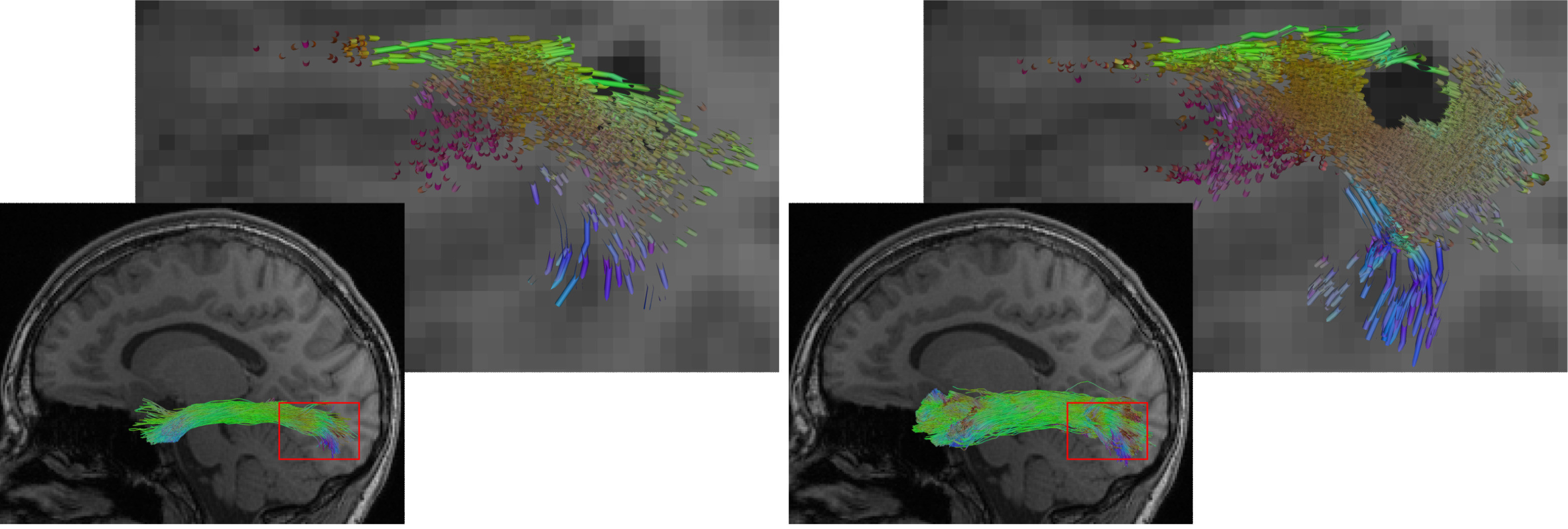 The illustration shows a reconstruction of the longitudinal inferior fasciculus (a fibre tract of the brain), on the left using a conventional AI method, on the right using the new hybrid approach. The hybrid approach enables a more complete reconstruction. At the same time, it more precisely omits lesions such as the dark region in the detailed view.